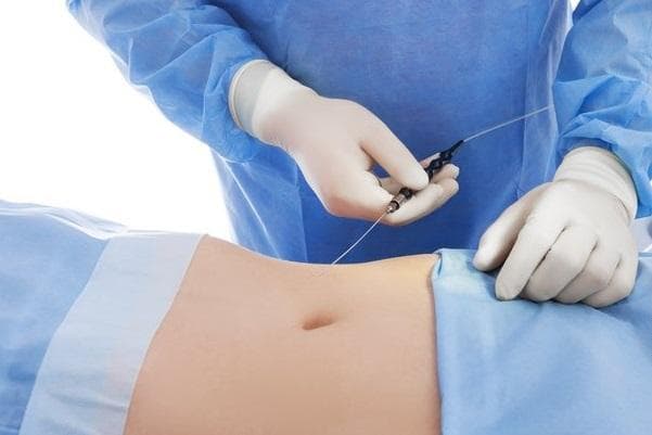 Laser Liposuction
